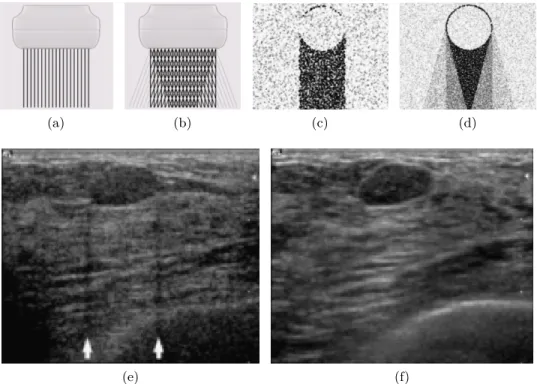 Figure 1.4: Comparison between conventional B-mode US imaging and real time spatial compound US imaging (sonoCT)