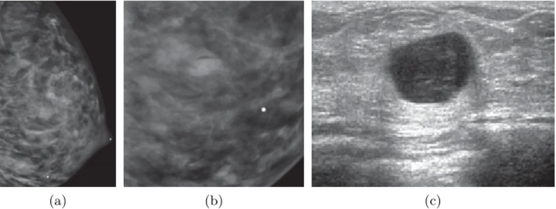 Figure 1.7: Example of lesion shield under DM screening and distinguishable under US screening taken from Hines et al