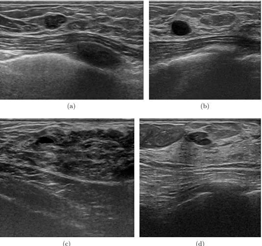 Figure 1.9: Breast Ultra-Sound (BUS) image examples of different adipose and fibro-glandular topologies with the presence of lesions