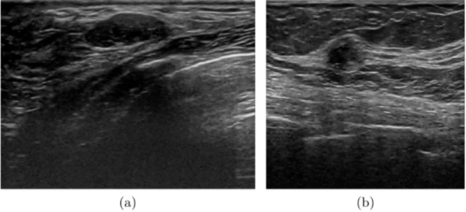 Figure 1.17: Lesion Boundary: (a) Abrupt interface. (b) Echogenic halo.