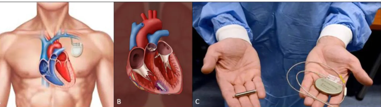 Figure 3.1 – Figure A) represents an implanted cardiac pacemaker. Figure B) represents a leadless cardiac pacemaker
