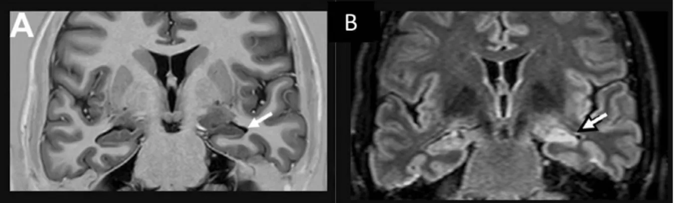Figure  I-2-1.  IRM  d’une  SH  gauche  avec  atrophie  et  désorganisation  interne  (flèche)  en  pondération T1 avec inversion-récupération (A) et hypersignal (flèche) en FLAIR (B) (Cendes et al