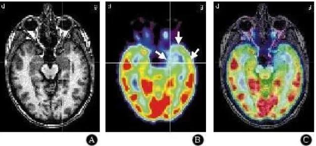 Figure I-2-4. TEP au  18 F-FDG dans l'épilepsie temporale interne. Recalage du TEP sur l’IRM