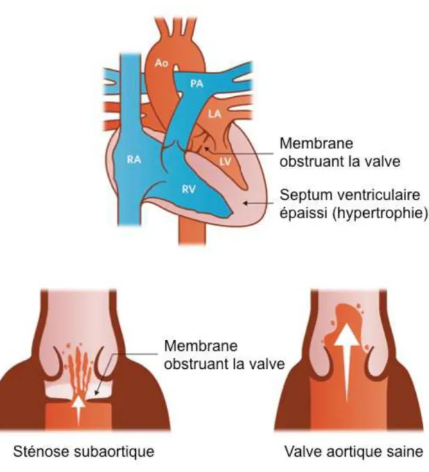 Figure 5 : Sténose subaortique. 