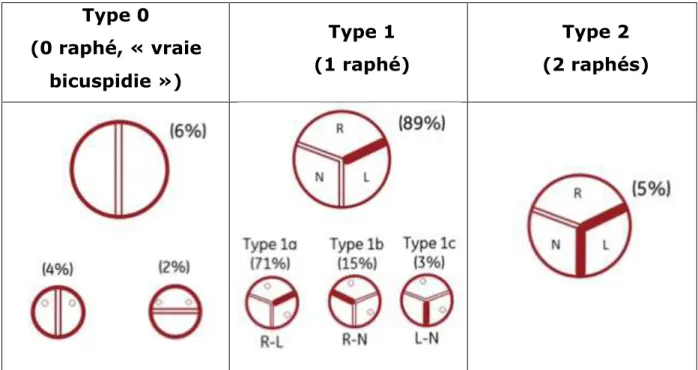 Tableau 1 : Classification et fréquences d'apparition des différents  types de bicuspidies aortiques