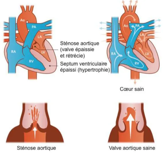 Figure 7 : Sténose aortique. 