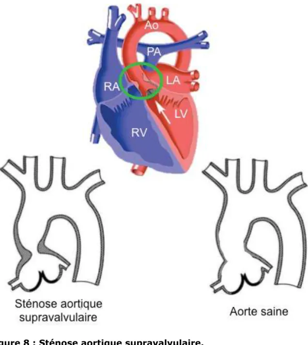 Figure 8 : Sténose aortique supravalvulaire. 