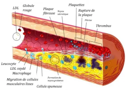 Figure 23 : Représentation schématique des différentes étapes impliquées dans la formation  d’une plaque d’athérome au niveau d’une artère