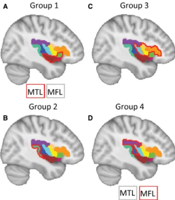 FIGURE 3  Clustered groups for clinical signs (A) and regions  (B) for the four groups of patients obtained with hierarchical clustering performed on new PCA coordinates