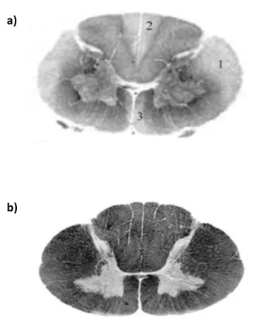 Figure 2.  Spinal cord frontal section of an HSP-patient (a: 1. Lateral column; 2. Dorsal column; 