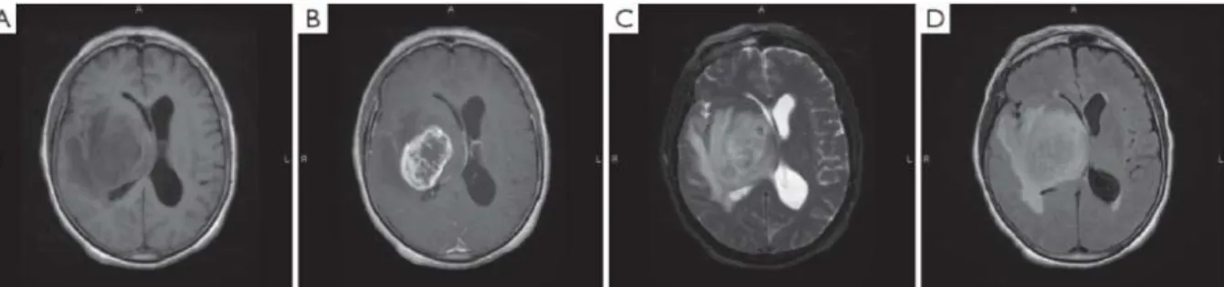 Figure 5 : Images IRM obtenues chez un patient atteint de GBM.  