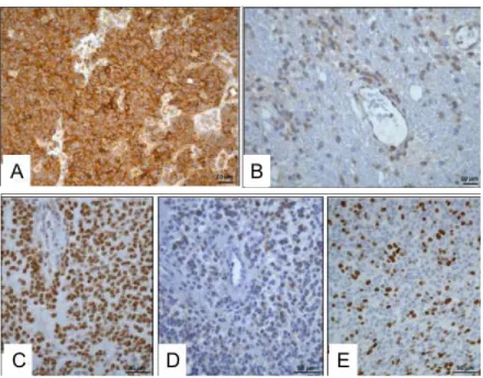 Figure 13 : Exemple de résultats immunohistochimiques obtenus pour un  GBM  canin  (A :  Marquage  nestin,  B :  Marquage  CD133,  C :  Marquage  Olig2, D : Marquage DCx, E : marquage Ki67)(Fernandez et al., 2016)