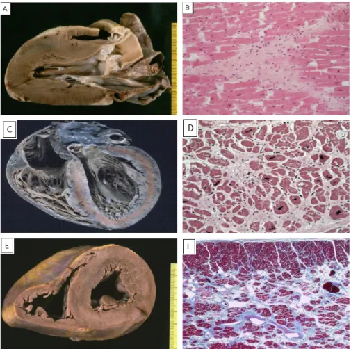 Figure 14 : présentation des images histologiques ainsi que des coupes microscopiques  rapportées dans le premier (A et B), second (C et D) et troisième cas (E et F)