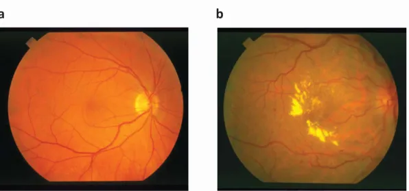 Fig. 2 shows a normal retinal vessel image and a background diabetic retinopathy retinal  vessel  