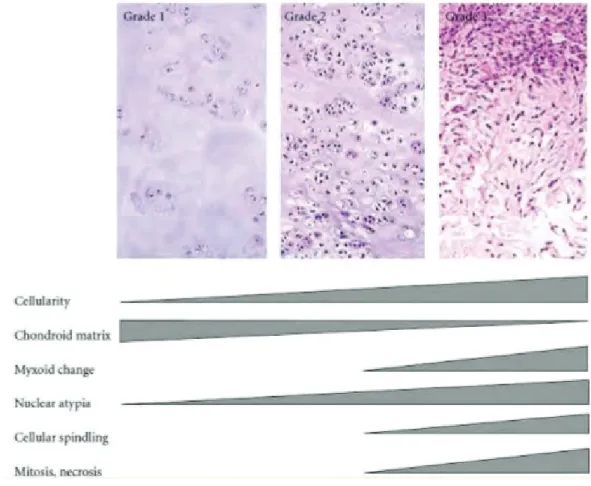 Figure 1.2: Histological grading of chondrosarcomas (2).  