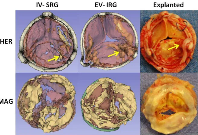 Fig. 4: Examples of segmentation results for cases HER (the yellow arrows show the  commissure lost because of leaflet prolapse) and MAG (the calcified pannus is well detected)