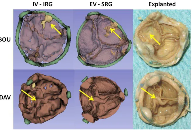 Fig. 5: Examples of segmentation results for cases BOU (yellow arrows show the calcified  leaflet) and DAV (yellow arrows indicate leaflet thickening)