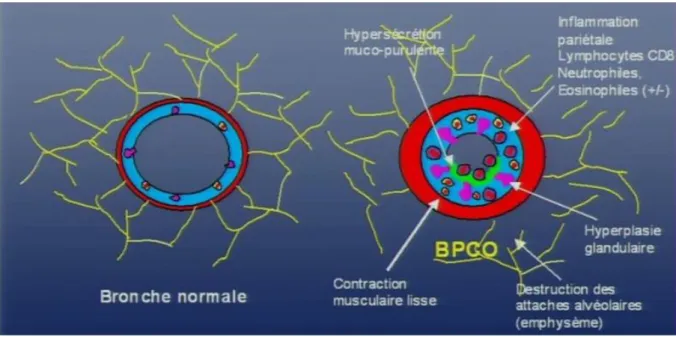 Figure  3.    Illustration  anatomique  du  remodelage  et  des  altérations  au  niveau  des  voies  aériennes      causées      par      la      réponse      inflammatoire      chez      les      patients      BPCO  (à      droite)  comparativement à des