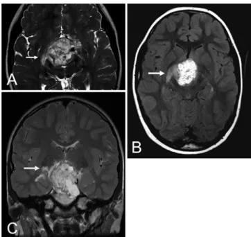 FIG. 2. Case 2. A 9-year-old boy with large retrochiasmatic craniopha- craniopha-ryngioma at diagnosis