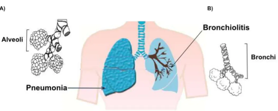 Figure 2 Differences between Pneumonia and Bronchiolitis.  