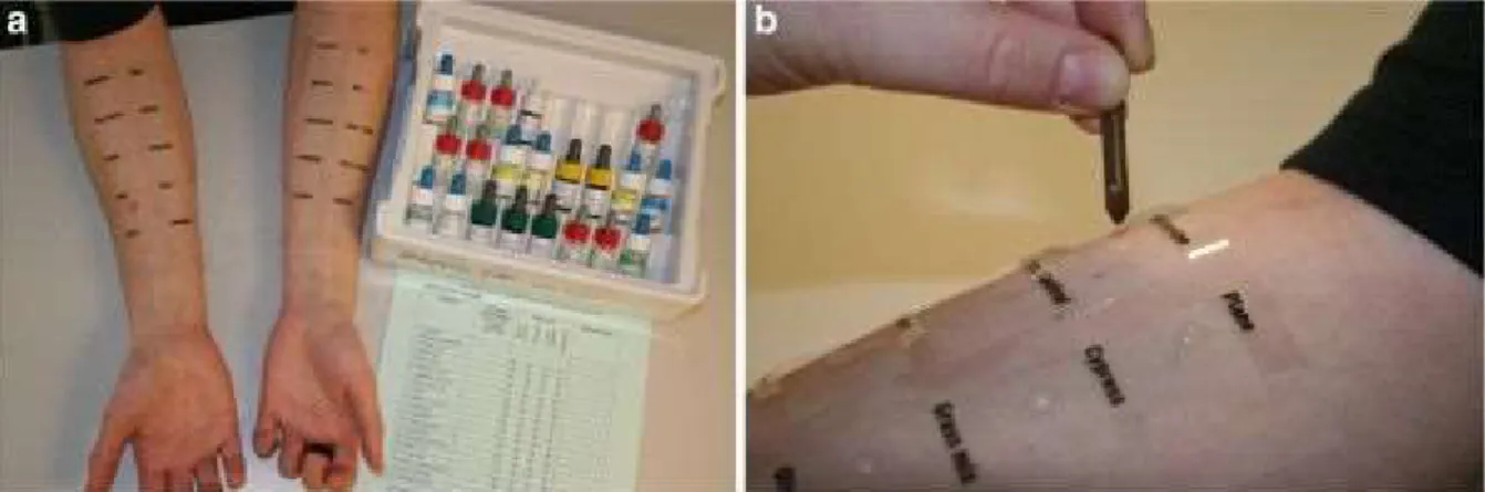 Figure 1.4 : Test de Prick effectué sur la peau du patient en utilisant différentes sources allergéniques