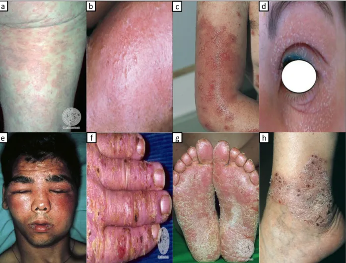 Figure 2 : aspects cliniques de la dermatite de contact allergique et lésions cutanées associées