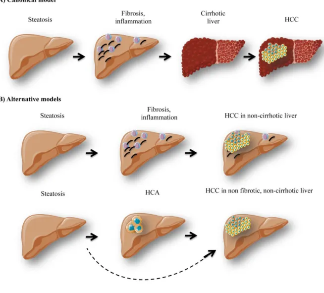 FIGURE 3: Different models of hepatocellular carcinoma development. The canonical model of hepatocellular carcinoma (HCC) devel- devel-opment (A) stipulates that patients with hepatic steatosis further develop inflammation / immune cell infiltration and fi