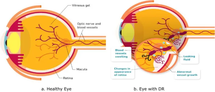 Fig. 12: A normal eye vs. DR eye showing abnormal leaking and vessels growth [17]