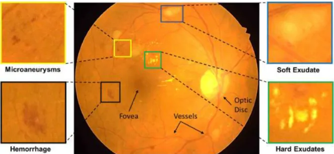 Fig. 14: Fundus retinal image representation in the center. Pointing to normal formations (fovea, vessels and  optic disc) and deformations related to DR: The left section (MAs), and HEs and in right( SEs), and (EXs) [20]