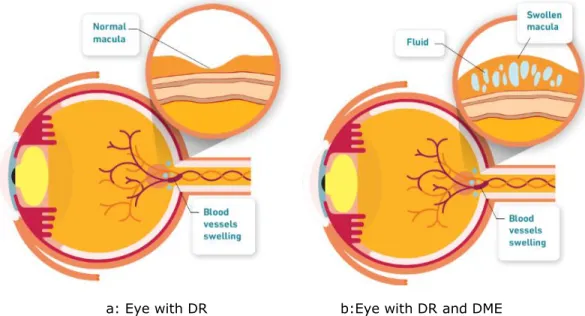 Fig. 16: DR vs. DME eye where swelling vessels in DR leads into leaking fluid in macula [17] 