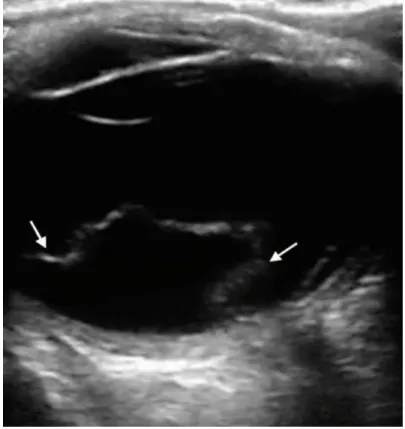 Fig. 22: An Ultrasonography presentation of retinal detachment [40]. 