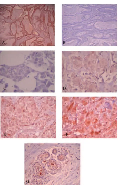 Fig. 1. A and B: Immunostaining of colorectal carcinoma (x400): (A): with anti-Aurora-A antibody: positive control, (B): without anti-Aurora-A antibody: n´egative control