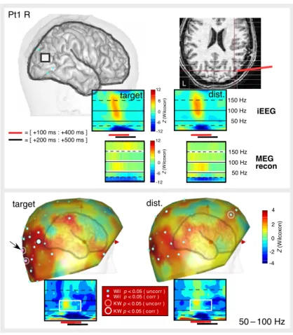 Fig. 2. MEG and iEEG GBR and ABS in patient Pt1 (right hemisphere). Top panel: MRI slice and 3D reconstruction showing a cortical site where significant GBR and ABS were observed in iEEG