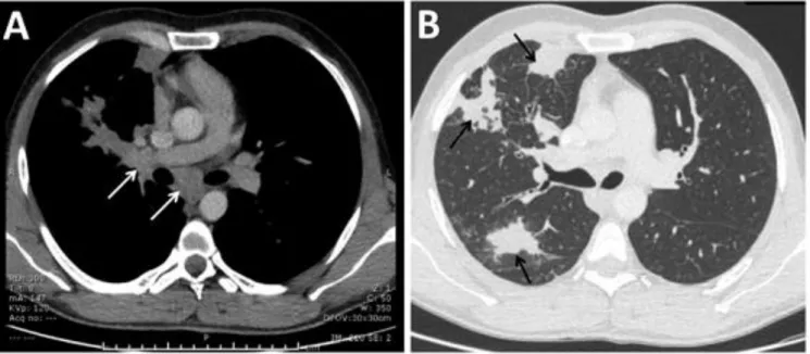 Figur e  S1:  Initial  CT  scan  showing  hilar  and  subcarinal  adenopathies  (A)  and  parenchymal  condensations (B)