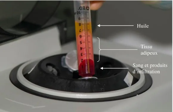 Figure 8 : Seringue de lipoaspirat après centrifugation. Le tissu adipeux à greffer est compacté dans la partie  intermédiaire, débarrassé en partie du liquide d’infiltration et de l’huile