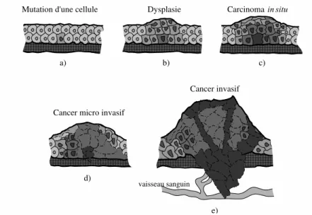 Fig. 1.1 – Représentation simplifiée des différentes étapes d’évolution d’un tissu épithélial cancé- cancé-reux