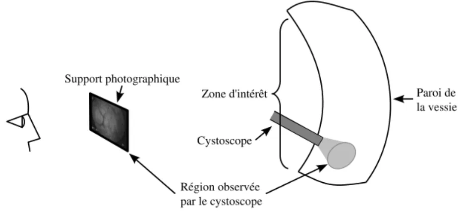 Fig. 1.9 – Illustration de la petite région pouvant être relevée par un support photographique cystoscopique actuel.