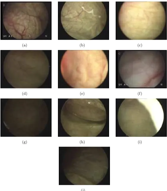Fig. 1.14 – Quelques exemples d’images pouvant être extraites d’une séquence vidéo- vidéo-cystoscopique