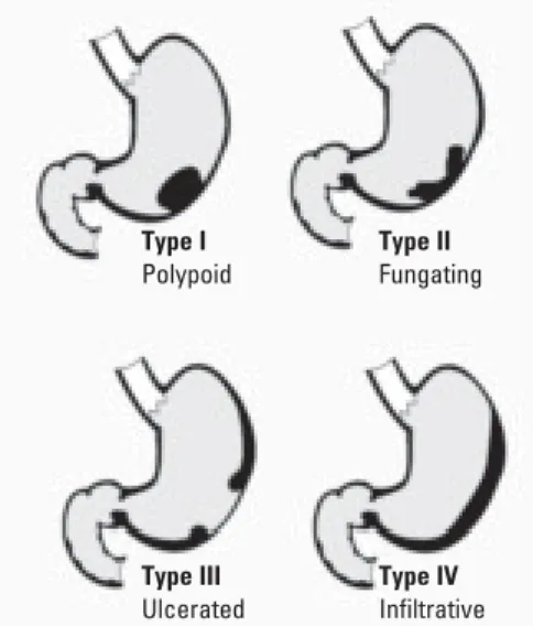 Fig. 3.06 Endoscopic views of gastric cancer (A, C) and corresponding images with dye enhancement (B, D).