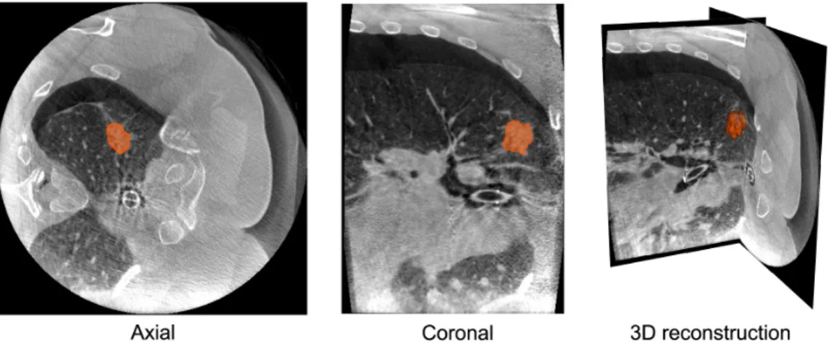 Figure 1.11: Manual delineation of a pulmonary nodule in an intraoperative CBCT image of a semi-deflated lung.
