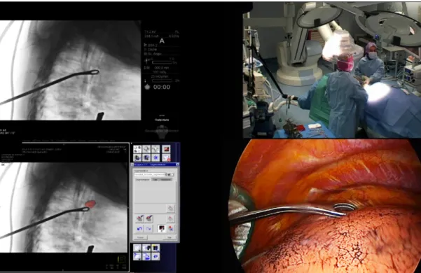 Figure 1.12: Intraoperative localization of a pulmonary nodule under fluoroscopic guidance