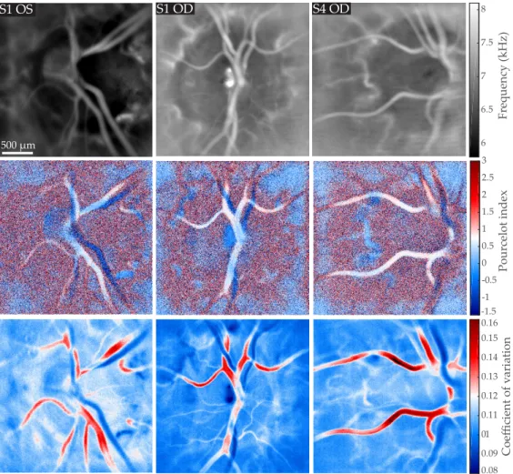 Fig. 4. Mapping in three different eyes of the local blood velocity, RI, and CV indices; all images are displayed on the same gray/color scale