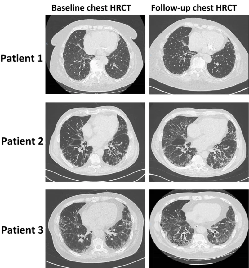 Fig 2. Representative baseline and follow-up chest high-resolution computed tomography performed for 3 patients with rheumatoid arthritis (RA)-associated interstitial lung disease (ILD)