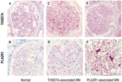Figure 1.6  –  Renal biopsy staining in PLA2R1– and THSD7A–associated MN and in a  healthy  control