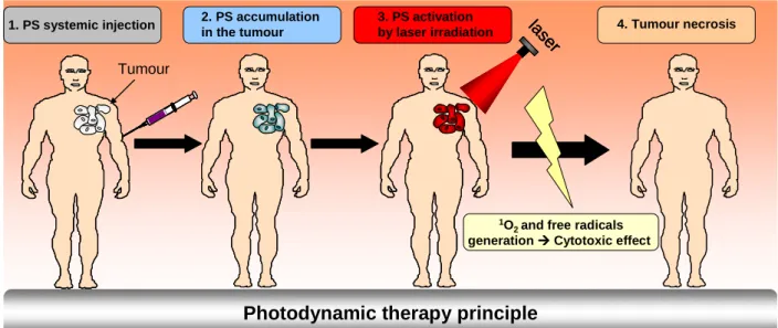 Figure  2:  Principle  stages  of  photodynamic  therapy.  A  photosensitizer  is  injected  intravenously  (Stage  I),  accumulates in the tumour (Stage II) and is then activated by external illumination (Stage III)