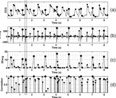 Fig 3 shows an example of the processed ECG signals and the features extracted in this paper.