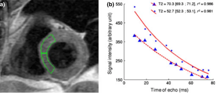 Figure 1 Illustration of our method to quantify myocardial T2. (a) Example of the positioning of the regions of interest for both septal segments