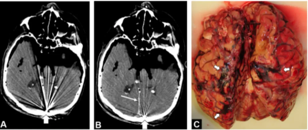 Figure 3. A 67-year-old man victim of a head gunshot would. A, CT image in the axial plane obtained with conventional iterative reconstruction at the level of temporo-occipital lobes with metallic projectile against inner occipital bone (large arrow) gener