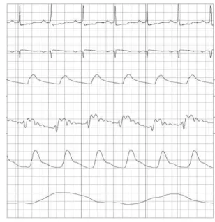 Fig. 1.2 – Exemple de signaux enre- enre-gistr´es par des syst`emes de monitoring cardiaques