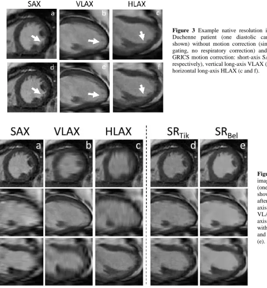 Table 1 Image sharpness indices obtained with/without motion correction and with/without super-resolution (mean ± standard deviation of N=20 patients)